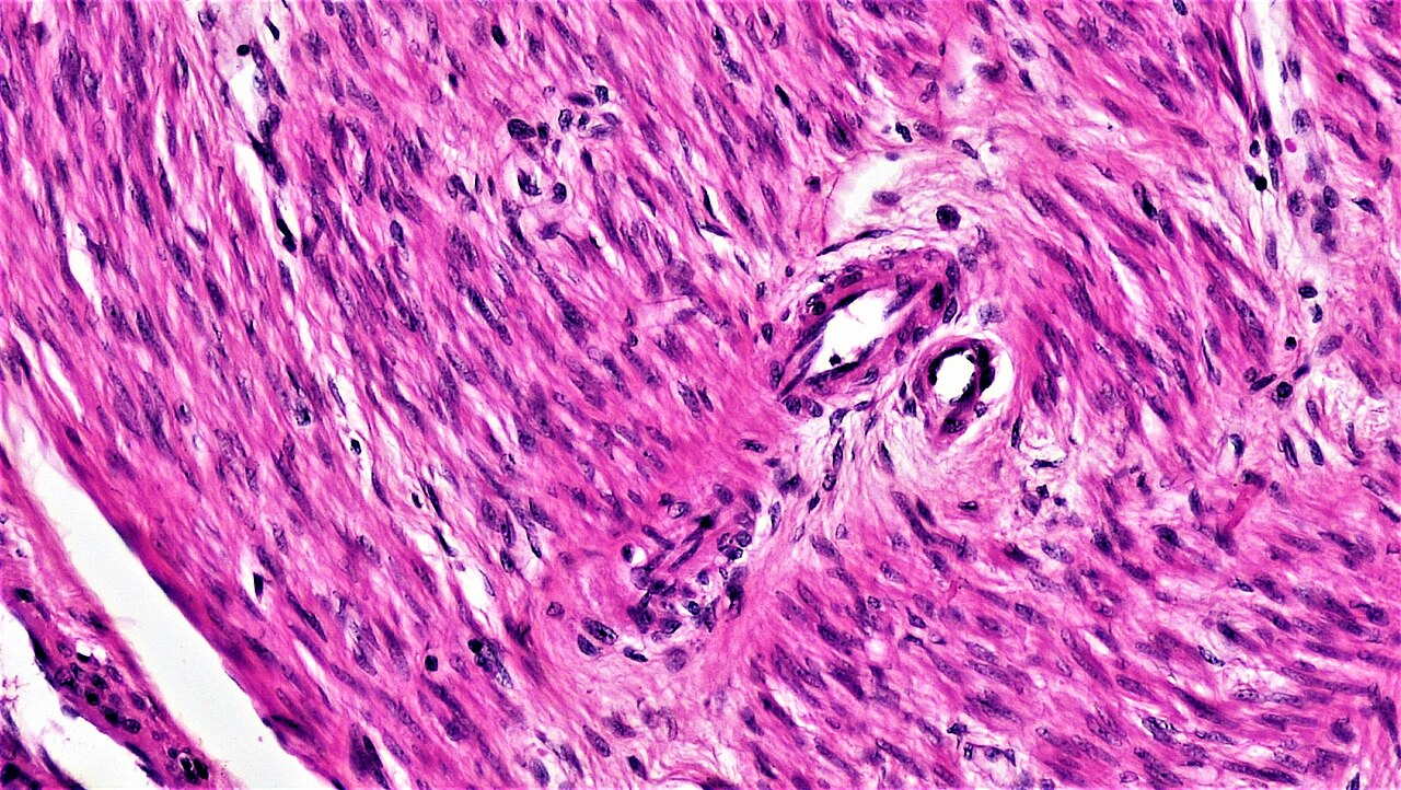 Interlacing pink bundles contain many elongated dark nuclei and narrower spindle-like cell profiles; no regular transverse striation pattern is resolved.